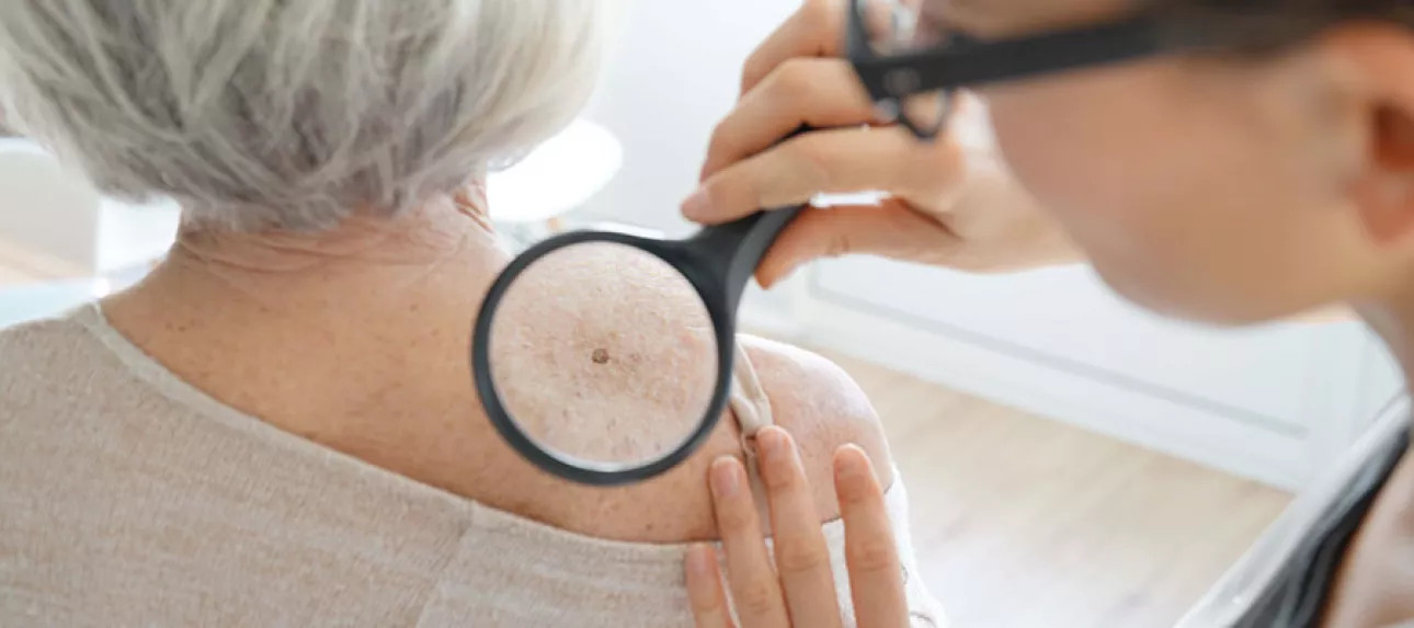 Maladie de la peau senior